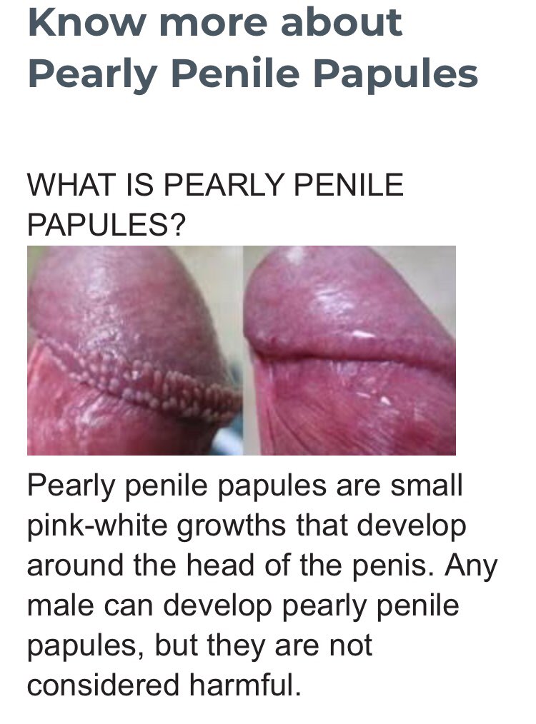 About pearly penile papules.