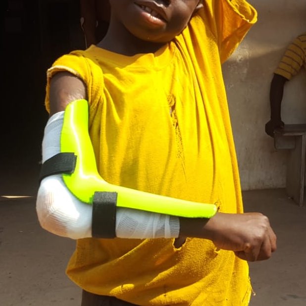Brouwers_3D's tweet photo. #3Dprinting in #SierraLeone 🇸🇱 Young children get often burned with post-burn scars and scar contractions. Our team performed surgical procedures and 3Dprinted casts to let the scars heal in the correct position! #simplesolution @Ultimaker @ETZnl @radboudumc @NVvTG @3DPrintBoard https://t.co/kt33Ef8EQ1