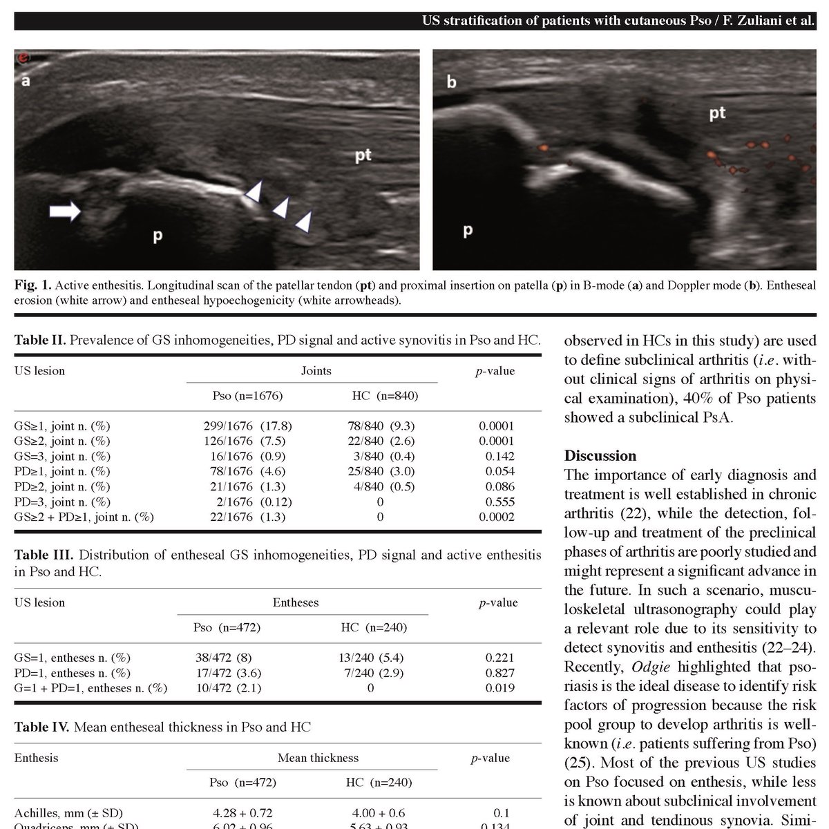 clinexprheum's tweet photo. #JulyAugustIssue: "Ultrasonographic detection of subclinical #enthesitis and #synovitis: a possible stratification of psoriatic #patients without clinical #musculoskeletal involvement"🆓to view https://t.co/Daxtz3chWI a relevant clinical step to better stratify psoriatic patients https://t.co/tSRherad9m