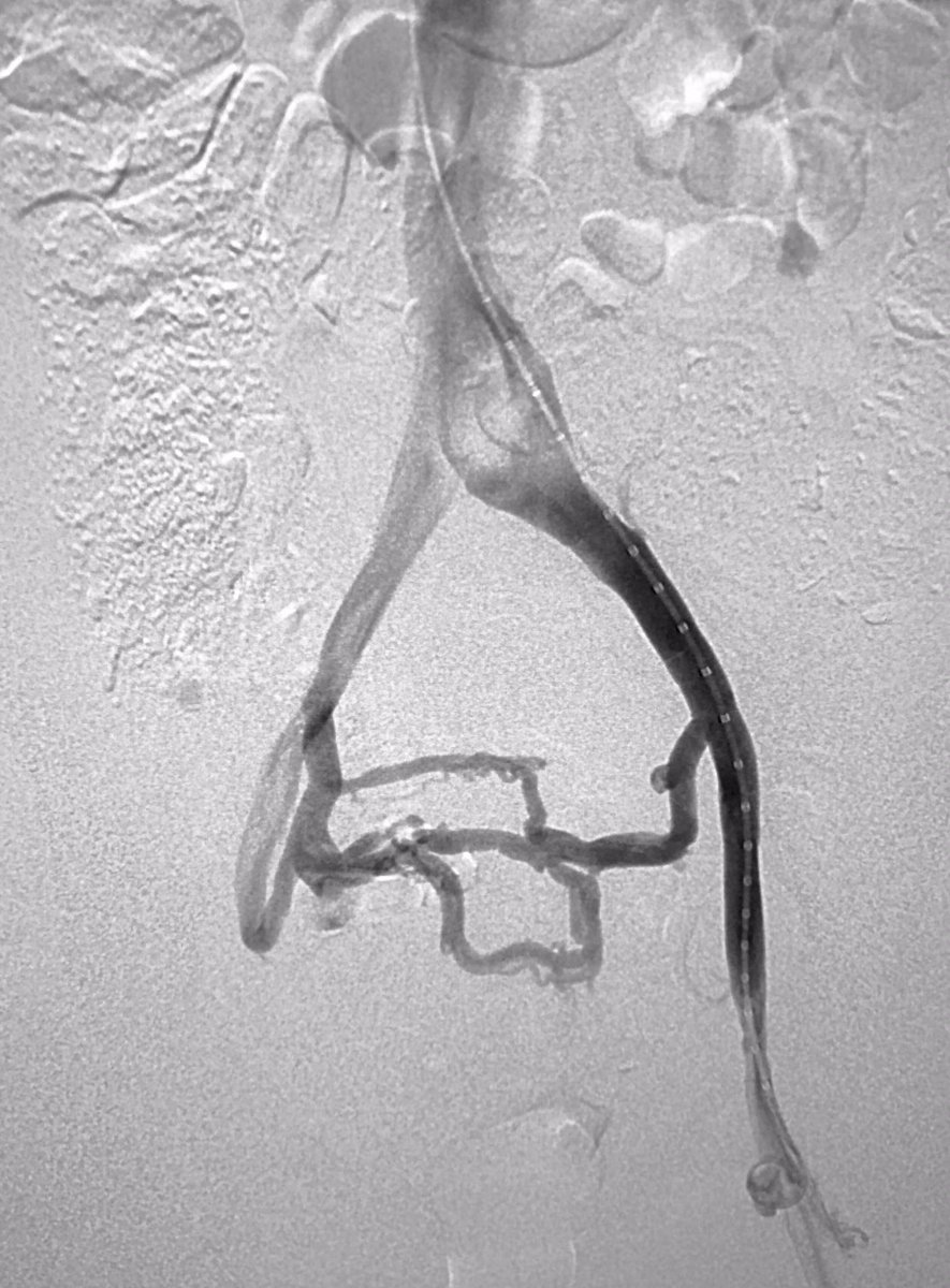 MTV_IR's tweet photo. 28 y/o F w/severe #pelvicpain from #MayThurnerSyndrome. L femoral #venogram demonstrates significant pelvic collaterals. Resolution of collateral after #iliacveinstent placement. #MTVIR #IRad #MIIPs #POTS
#ViciVenousStent #InterstitialCystitis
#PelvicCongestionSyndrome #PCS https://t.co/BBBgBQrGUs
