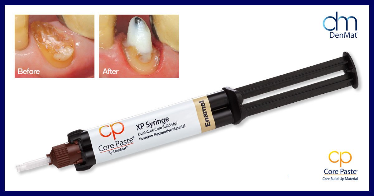 denmatdental's tweet photo. Core Paste® and Core Post® have helped thousands of Dental Professionals perform reliable core build-ups with complete confidence for over 30 years.
Learn more at:
https://t.co/Ukqf92407l
#DenMat #CorePaste #Dentistry https://t.co/4UF8tbz7gl