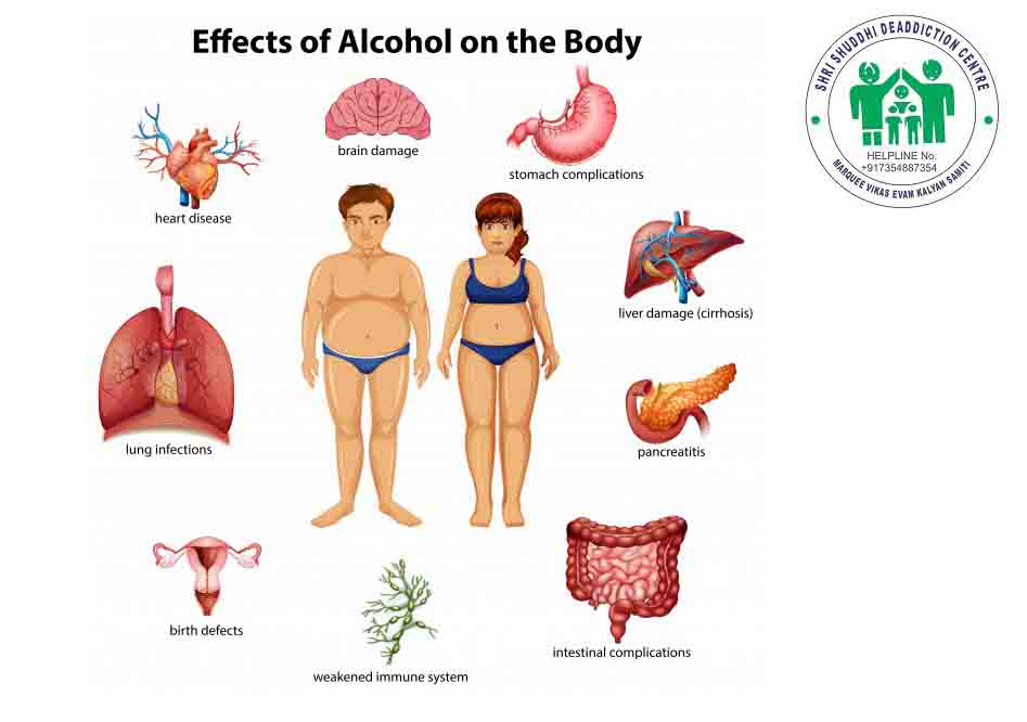 Effects of Alcohol on Your Body - Effects of Alcohol -  #AlcoholicSymptoms #Drugfreeindia #Addiction #Recovery #Alcohol #EffectsOfAlcohol #ShriShuddhiDeaddictionCentre bit.ly/30SqJT2