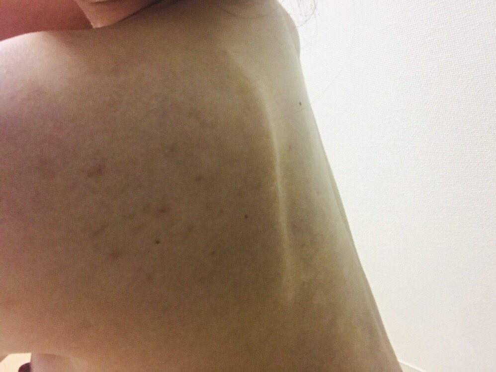 のん 久しぶりの背中更新 私は元々せなか中にアザ があって 汚く感じるけれどニキビ跡もかなり薄くなってきた 自力でもなんだかんだここまではできるのね 背中ニキビ ニキビ跡 クレーター 背中ニキビ跡 のん 久しぶりの背中更新 私は元々せなか中にアザ があって 汚く感じるけれどニキビ跡もかなり薄くなってきた 自力でもなんだかんだここまではできるのね 背中ニキビ ニキビ跡 クレーター 背中ニキビ跡