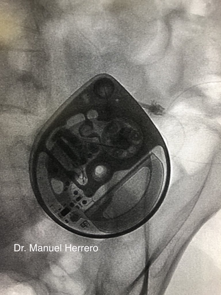 herrero_dr's tweet photo. Pain worsening in Oncology patient in spite of increasing spinal drug delivery. Doubts about intrathecal tip position with pumpogram, but CT scan never lies #spinalinfusion #cancerpain #pumpogram #interventionalmanagement #cido (Centro Integral de Dolor Oncológico) @HMHOSPITALES https://t.co/mLu3MtIHen