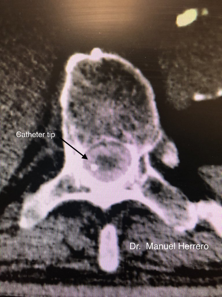 herrero_dr's tweet photo. Pain worsening in Oncology patient in spite of increasing spinal drug delivery. Doubts about intrathecal tip position with pumpogram, but CT scan never lies #spinalinfusion #cancerpain #pumpogram #interventionalmanagement #cido (Centro Integral de Dolor Oncológico) @HMHOSPITALES https://t.co/mLu3MtIHen