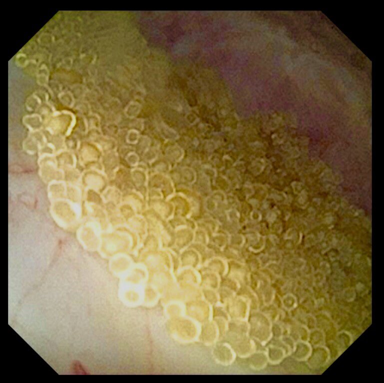 Shresthanyl's tweet photo. “Fish eggs”-Renal Calculi. Amazing Beauty. Keep doing #RIRS keep exploring beautiful things. https://t.co/52hnNLVuwZ
