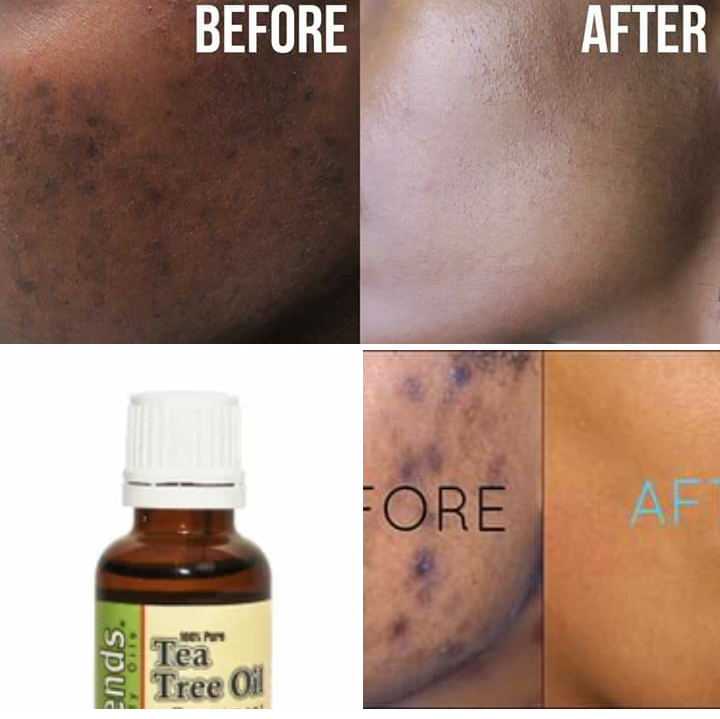 Doctorsarah3's tweet photo. Blacksport removal product is now available.
Kindly wtsapp or call us  on +27799196969
Email.docsarah2018@gmail.com https://t.co/JBuXF76SFd