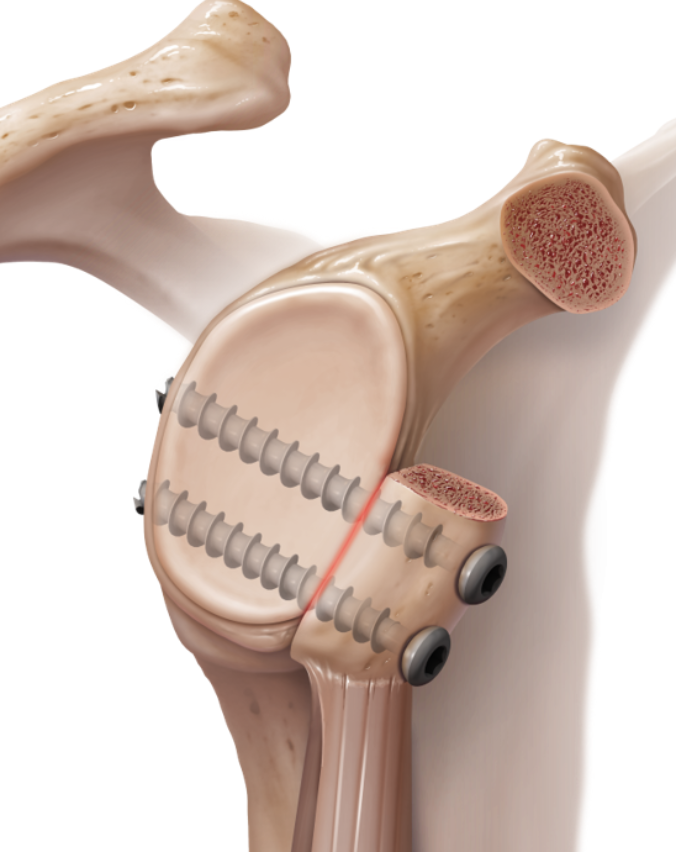 MillettMD's tweet image. The #LatarjetProcedure is becoming a preferred method of treatment for #AnteriorShoulderInstability. This procedure is successful approximately 80-95% of the time in eliminating recurrent #ShoulderInstability and #dislocations

medilink.us/a3zu