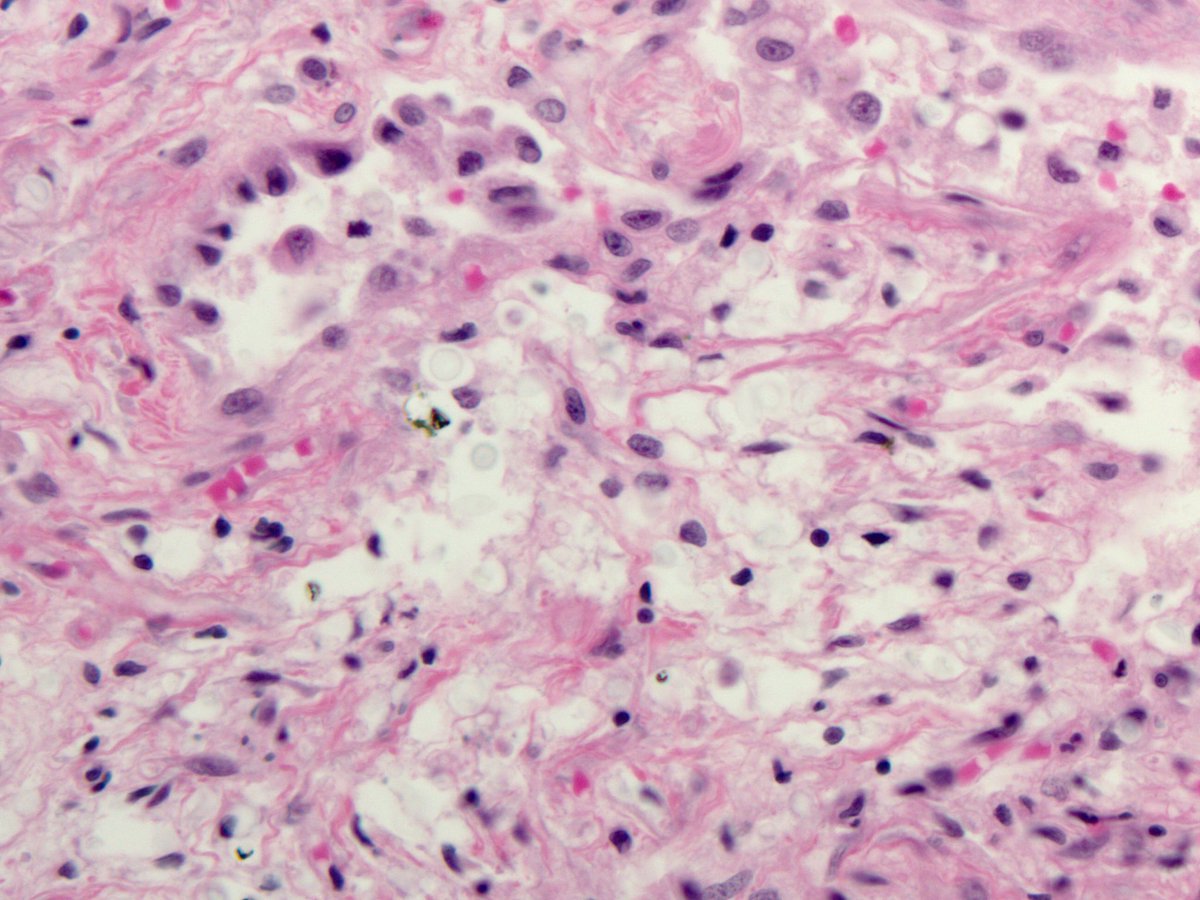 smlungpathguy's tweet image. See the halo around these #Cryptococcus yeasts? Textbooks say it’s the capsule. If this were true, the halo would stain with mucicarmine. It doesn’t! 😬😳🧐

The halo is an artefact caused by retraction of the cytoplasm of the cell engulfing the yeasts 

#pathology #pulmpath