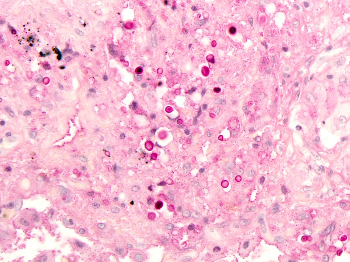 smlungpathguy's tweet image. See the halo around these #Cryptococcus yeasts? Textbooks say it’s the capsule. If this were true, the halo would stain with mucicarmine. It doesn’t! 😬😳🧐

The halo is an artefact caused by retraction of the cytoplasm of the cell engulfing the yeasts 

#pathology #pulmpath