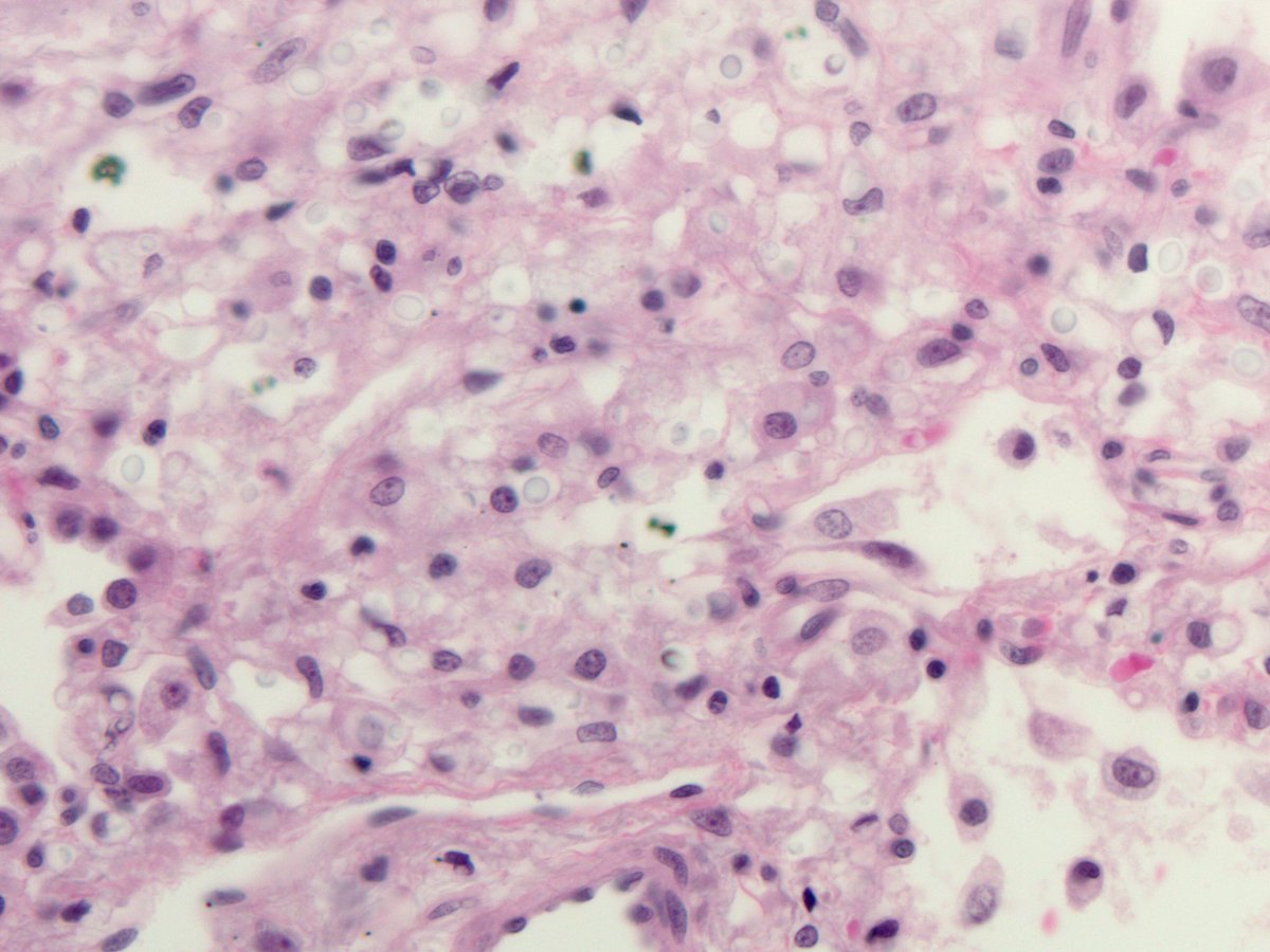smlungpathguy's tweet image. See the halo around these #Cryptococcus yeasts? Textbooks say it’s the capsule. If this were true, the halo would stain with mucicarmine. It doesn’t! 😬😳🧐

The halo is an artefact caused by retraction of the cytoplasm of the cell engulfing the yeasts 

#pathology #pulmpath