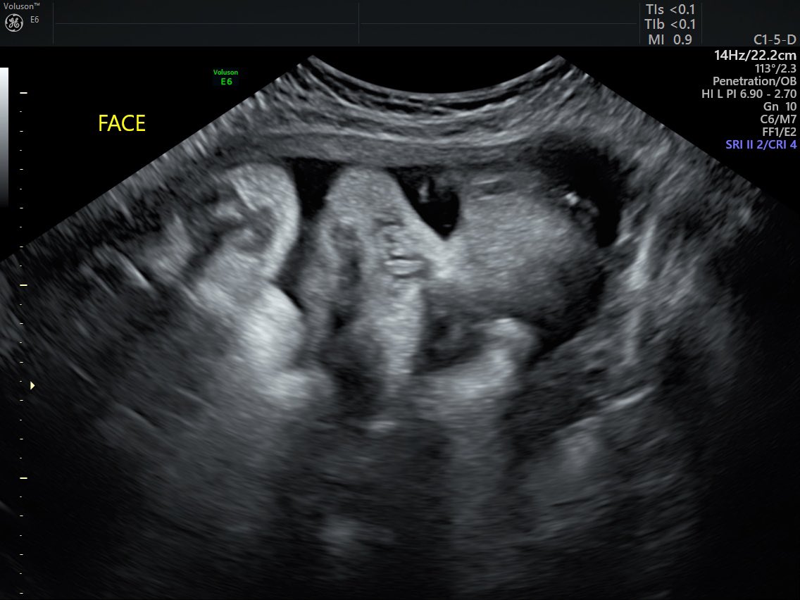 allychapa16's tweet photo. Saw Baby boy today for my last sono before his arrival 💙 he is already in head down position weighing almost 6 lbs & mama is dialated to a 2 already 🤩 #4weeksorless https://t.co/2sNhEKvr5L