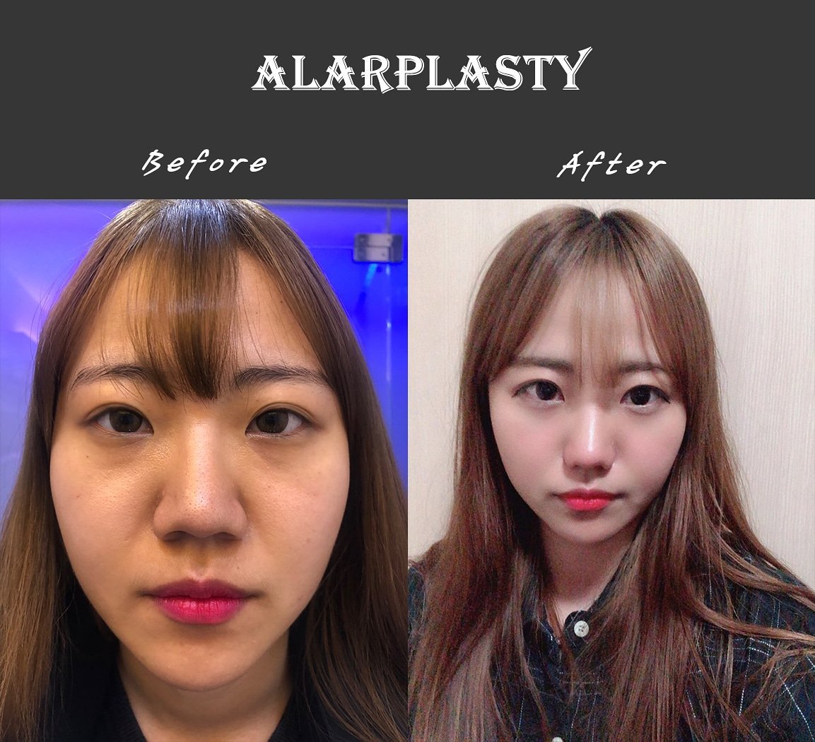 PsSeoul's tweet photo. Before and after pictures of alarplasty
#plasticsurgery #alarplasty #nosejob #rhinoplasty #beforeandafter #seoulqueenplasticsurgery #콧볼축소 #코수술 #전후 #후기 https://t.co/kDE57DLj4V