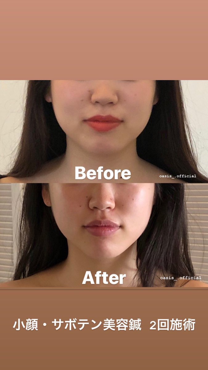ミナミのオアシス ビフォーアフター オアシスでは施術前後に ビフォーアフターの写真を撮影します 初回からの変化などをしっかり 実感して頂きます 美容鍼 小顔 美容整体 ビフォーアフター 夏 祭り 花火 海