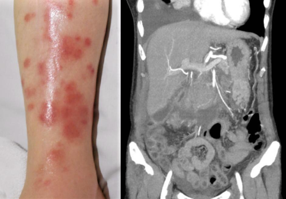 Pancreatic panniculitis. Skin of the lower leg, biopsy. HE, gross and enhanced CT. #pathology #Dermpath #GIpath