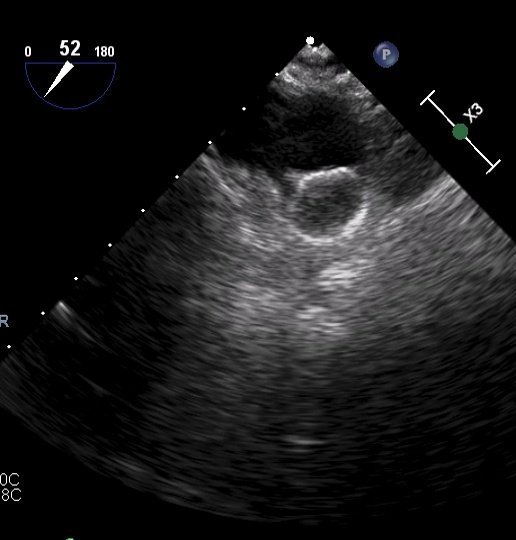 Felipe Bisbal (@bisbal_ep) on Twitter photo Our first LAAO with #Sentinel cerebral protection device in a patient with persistent LAA thrombus despite OAC, mechanical MVR and AF. Great team work with <a href="/ENofrerias/">Eduard Fdz-Nofrerias</a> <a href="/Xavi_Carrillo7/">Xavier Carrillo</a> <a href="/victoria_vilata/">Victoria Vilalta</a> at <a href="/hgermanstrias/">Hosp. Germans Trias</a> #EPeeps Our first LAAO with #Sentinel cerebral protection device in a patient with persistent LAA thrombus despite OAC, mechanical MVR and AF. Great team work with <a href="/ENofrerias/">Eduard Fdz-Nofrerias</a> <a href="/Xavi_Carrillo7/">Xavier Carrillo</a> <a href="/victoria_vilata/">Victoria Vilalta</a> at <a href="/hgermanstrias/">Hosp. Germans Trias</a> #EPeeps