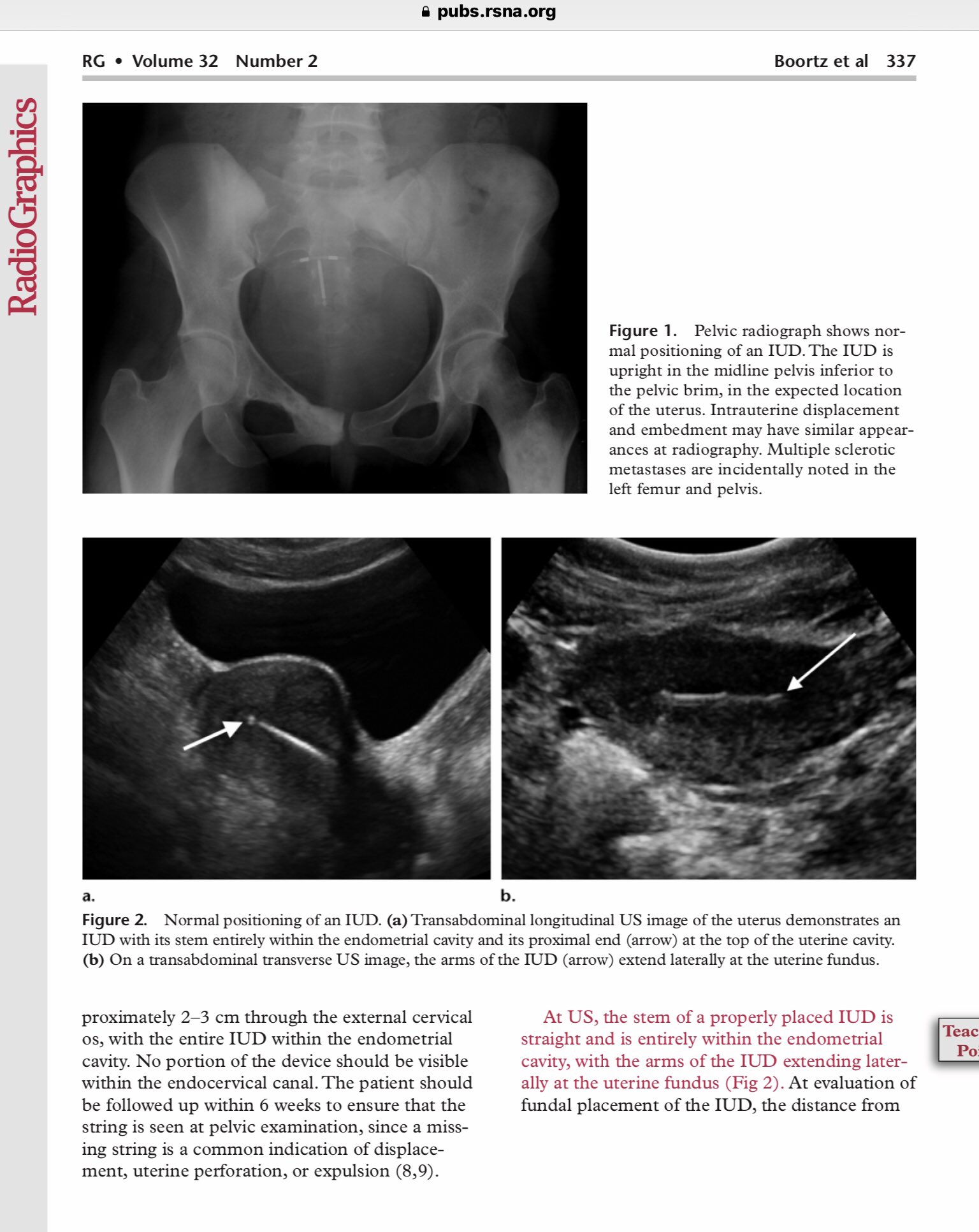 Fibroid Network Uk Fibroids בטוויטר Iud Implant Poor Position Migration Displacement Can Lead To Pain Heavy Bleeding Between Periods Pregnancy With Without Iud Ultrasound Can Detect Iud Position Radiographics Rcgp Gponlinenews