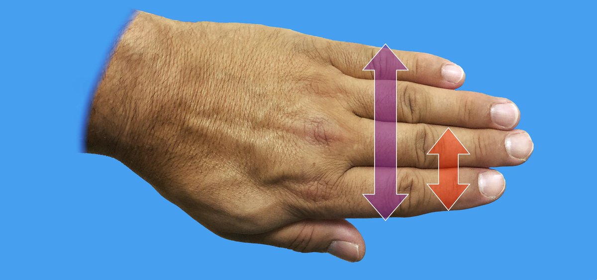 Dr.J.Sanchez-Sotelo (@jsanchezsotelo) on Twitter photo Are you interested in a simple rule to estimate distances to the radial nerve in elbow surgery? You can read the open access paper by Simone et at shoulderelbow.org/research/ <a href="/ASESmembers/">American Shoulder and Elbow Surgeons</a> @AAOSmembers <a href="/JSESMedia/">JSES</a> <a href="/MayoClinic/">Mayo Clinic</a> <a href="/MayoOrthoRes/">Mayo Orthopedic Residency</a> Are you interested in a simple rule to estimate distances to the radial nerve in elbow surgery? You can read the open access paper by Simone et at shoulderelbow.org/research/ <a href="/ASESmembers/">American Shoulder and Elbow Surgeons</a> @AAOSmembers <a href="/JSESMedia/">JSES</a> <a href="/MayoClinic/">Mayo Clinic</a> <a href="/MayoOrthoRes/">Mayo Orthopedic Residency</a>