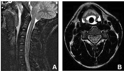 JChildNeurol's tweet photo. Acute flaccid myelitis: a review of presentation, diagnostics, treatments, and current research. https://t.co/12KTq4NtHe #AFM #neuroreview https://t.co/uyPFBhEZ27