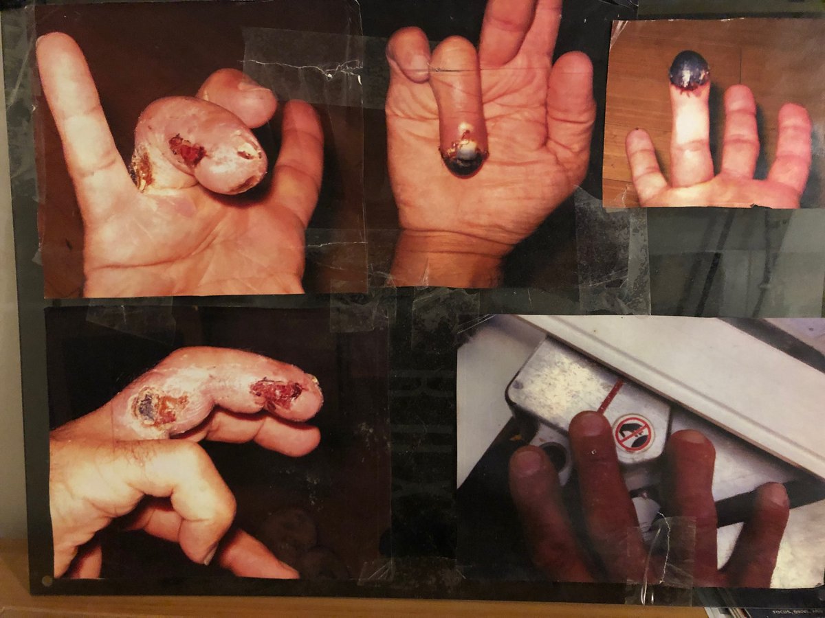 YetDiscovered's tweet image. ⁦@KeiserFitness⁩ manufactured a spin bike that did this to my hand &amp;amp; spent hundreds of thousands of dollars (guessing as to amount but it was a lot) to get judge to rule that they don’t need to compensate me at all. No warnings on the bike. B carful using keiser equipment!