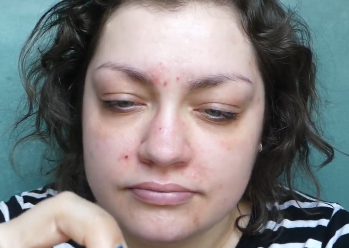 VVajazzles's tweet photo. Just because I attacked my face and made it look like I exfoliate with a cheese grater doesn't mean that Curology isn't working.  I would never lie for sponsorship money, even though that's exactly what I did.  #thriftthick https://t.co/2MODNP8xAW