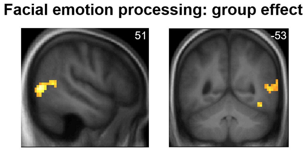 Brain On Twitter Marshall Et Al Describe The Functional - 