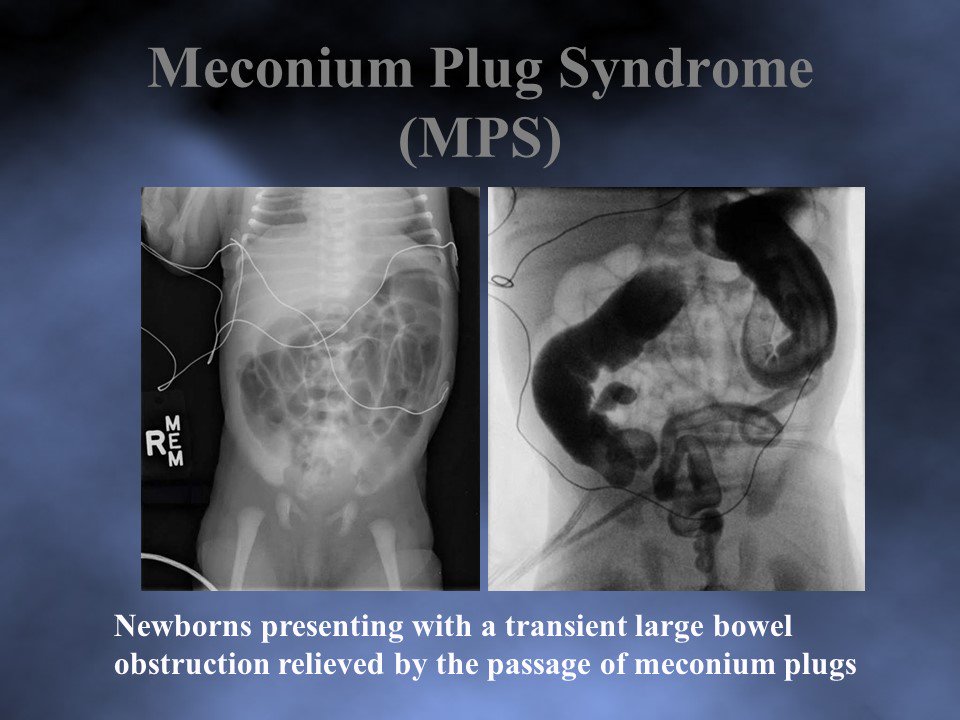 StayCurrentMD's tweet photo. 🔷Consider Hirschsprung disease in patients with meconium plug syndrome
🔷Early rectal biopsy may prevent delayed diagnosis
#staycurrent2019 #PullThePlug https://t.co/MU4NbV9PS6