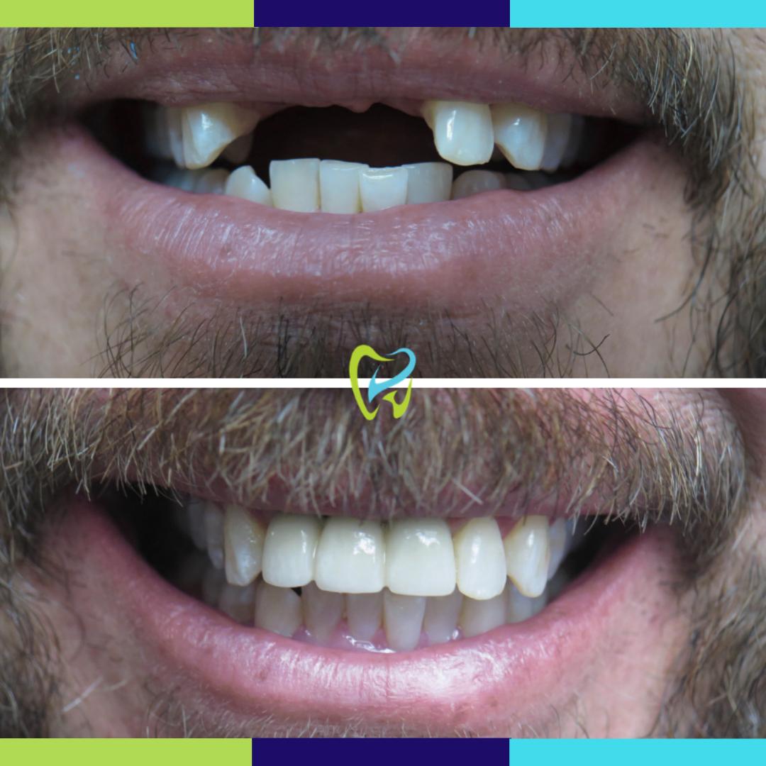 Dental Implants are a great way to upgrade and complete your smile! Learn about our Dental Implants: dentistoftorrance.com/dental-implant…

(310) 773-5971
dentistoftorrance.com