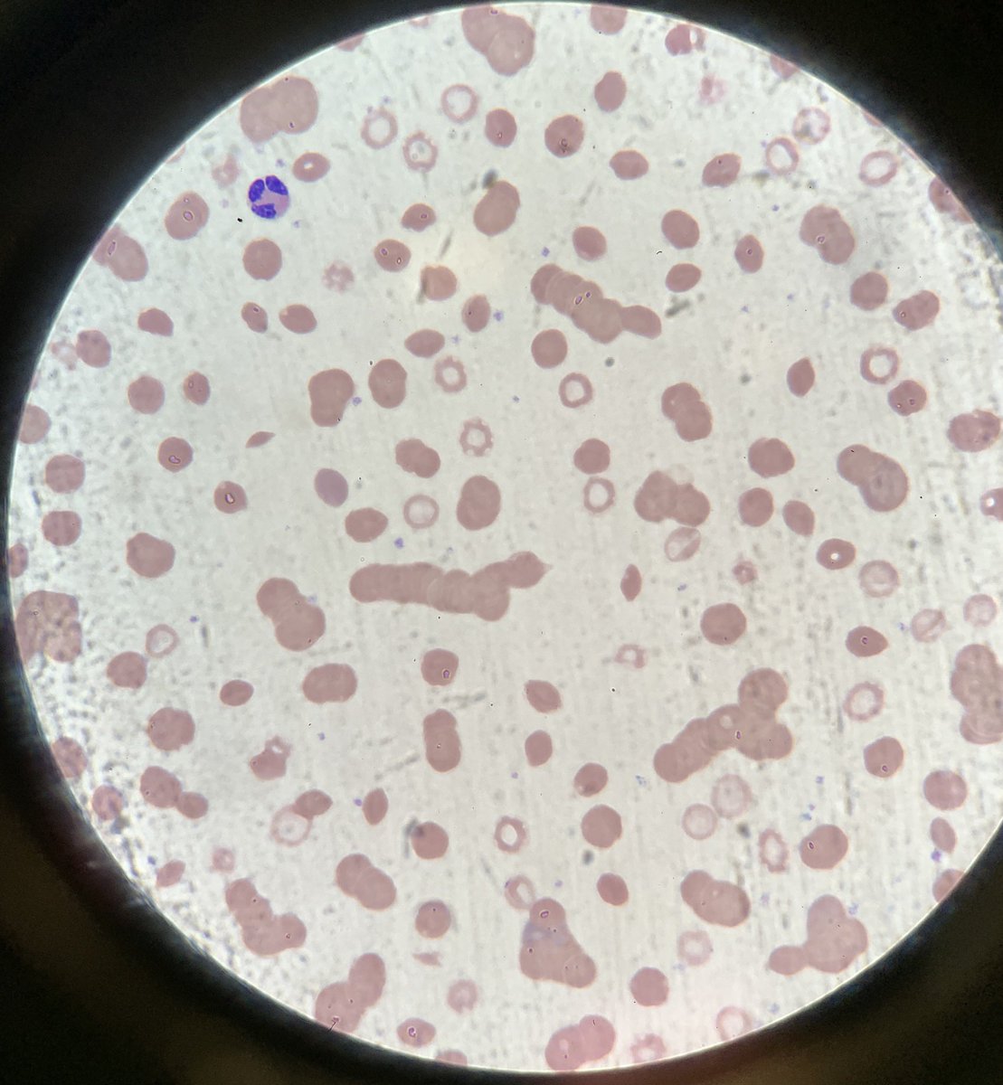 Patient presented to clinic with mental fogginess and abnormal lab results. Here is the smear. Got the diagnosis?  #meded 1/