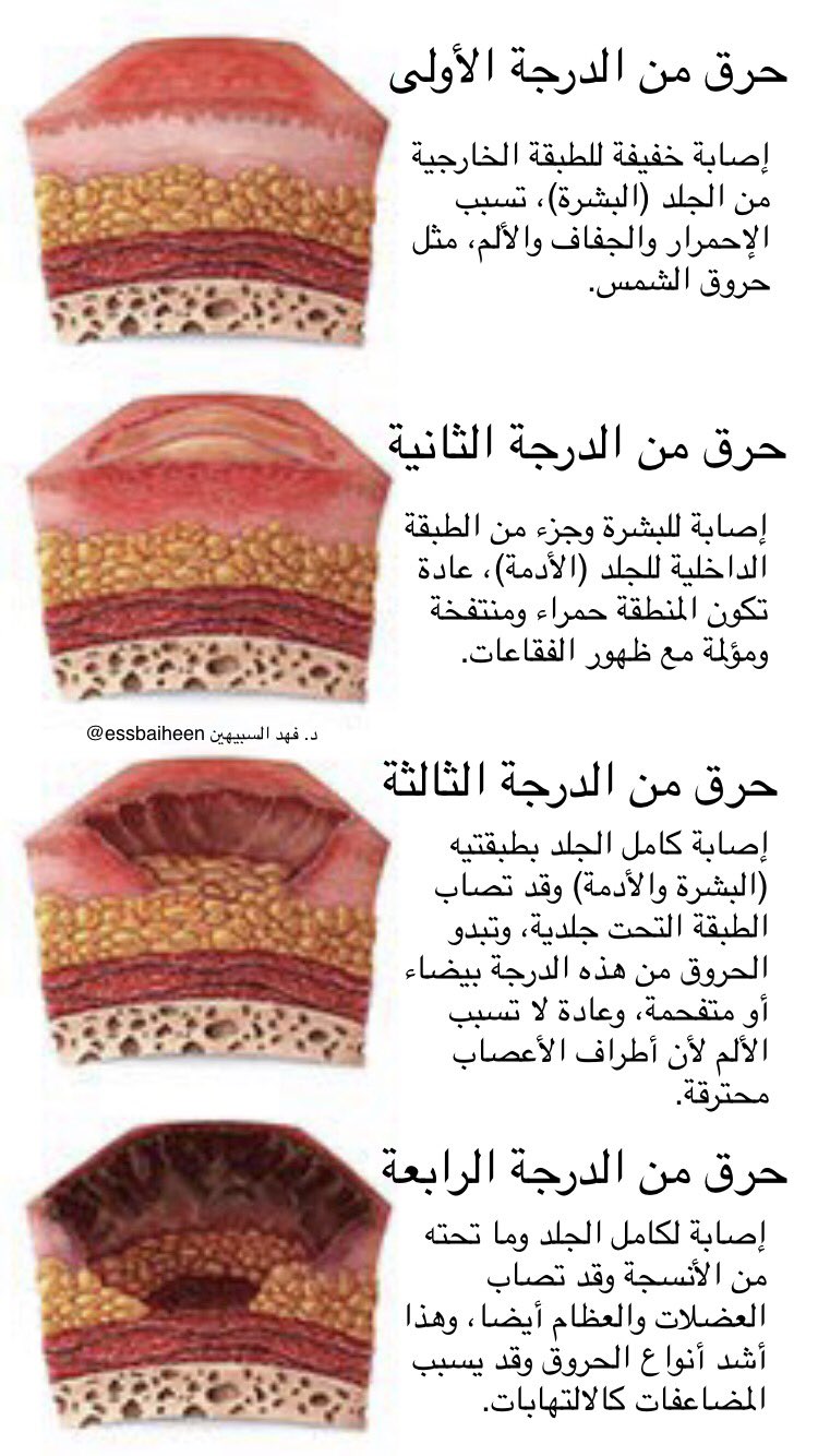 فهد السبيهين on twitter سمعتم عن الحروق ودرجاتها تفصيل تلك الدرجات وأعراضها فيه هذه الصورة https t co slh4962akv twitter