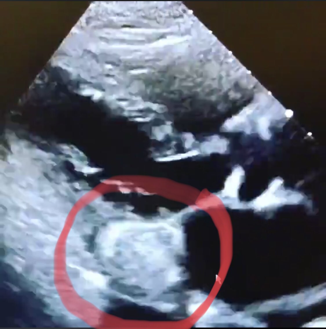 iamritu's tweet photo. @SandeepHedgire @ghoshhajra @kimberlyparks @ChamsiPash @cshenoy3 @onco_cardiology @RezaEmaminia @MGHHeartHealth @JagSinghMD @JJheart_doc @DPipilasMD @DrClaudiusMahr Thank you !Beautiful images!
#echofirst also see large, round, echo‐dense posterior mass w smooth borders in periannular region, with no acoustic shadowing artifact but #yescct is even clearer! #caseous #MAC #toothpaste https://t.co/c0dMtTpspI