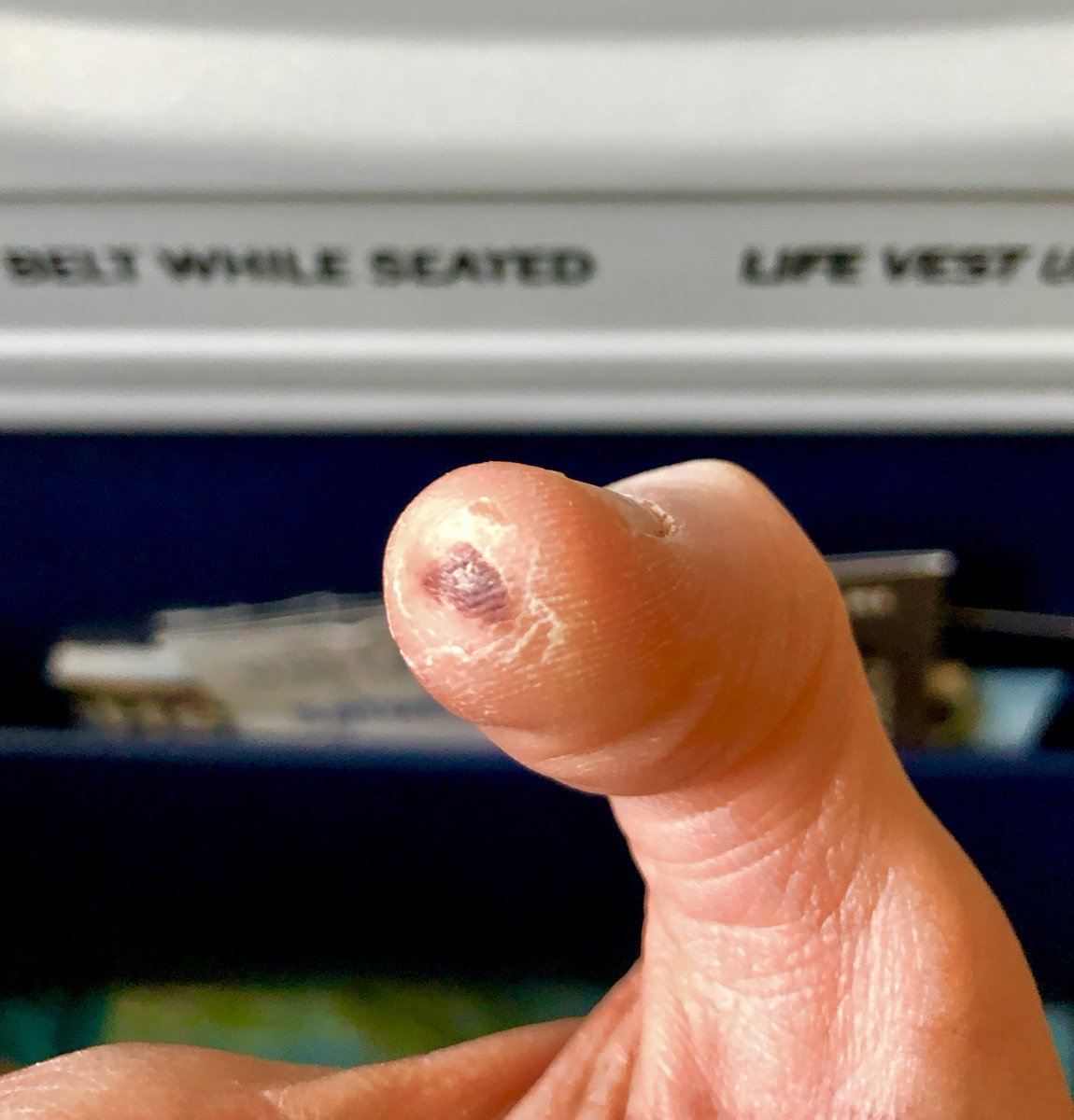 Yolanda_Harp's tweet photo. My right thumb lives to torment me.
#harpist #harpproblems #harplife https://t.co/6xLW3VWJ7f