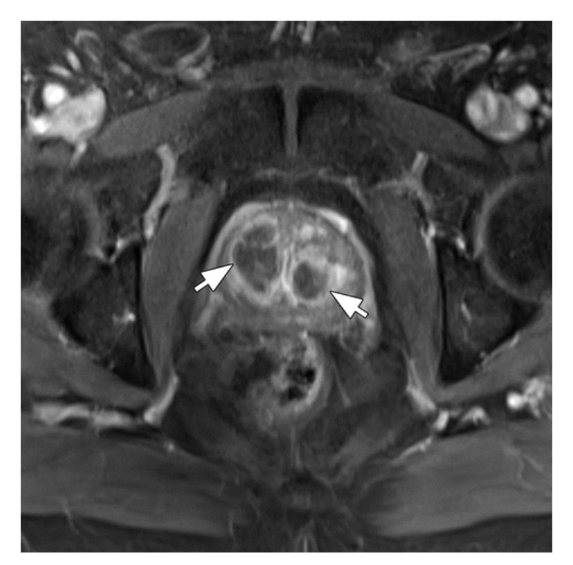 Ari Isaacson (@ariisaacsonmd) on Twitter photo Congrats to <a href="/AndrewPicelMD/">Andrew Picel</a> on an amazing article in <a href="/RadioGraphics/">RadioGraphics</a> on PAE. Chock full of great information and beautiful images. Congrats to <a href="/AndrewPicelMD/">Andrew Picel</a> on an amazing article in <a href="/RadioGraphics/">RadioGraphics</a> on PAE. Chock full of great information and beautiful images.