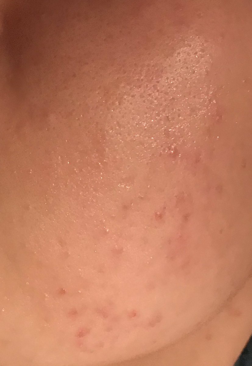 ニキビ肌克服チャレンジ 4mzci2teodpcbod Twitter