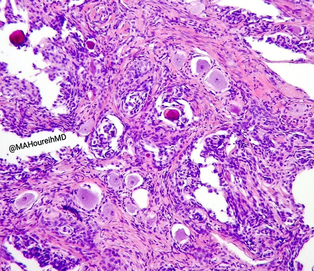 MAHoureih's tweet photo. #pathology #pathquizz A rare tumor for this weekend! 20🙍♂️@tralimiguel @PathologySayah @Path_Matt @Pathmath1 @DrMarkOng @TheKarenPinto @NigarAKhurram @sam_albadri @DrRolaAli @preethijaison @LiveLovePath @AyshaMubeen86 @D4L14H @AmyHDeekenMD @BinXu16 @kis_lorand @vi_monappa https://t.co/6k6kO8vqx2