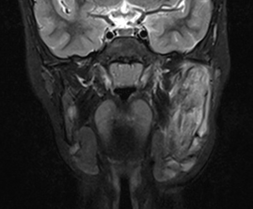 TimLuijkx's tweet photo. @dr_jbj: chronic recurrent multifocal osteomyelitis (CRMO, somewhat of a misnomer) is inflammatory osteitis
often diagnosed by exclusion, but lesion location/morphology with clinical assessment may enable diagnosis without biopsy. @Radiopaedia #RadReview
https://t.co/LklsC9aMUN https://t.co/i7Dsti8f97
