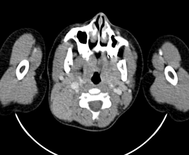 TimLuijkx's tweet photo. @dr_jbj: be mindful of seemingly unrelated information, e.g. a history of biliary atresia may prompt to look for evidence of liver transplant, which in turn would raise the possibility of post-transplant lymphoproliferative disease @Radiopaedia #RadReview
https://t.co/aQUeootZbm https://t.co/E6qgMDHVH0