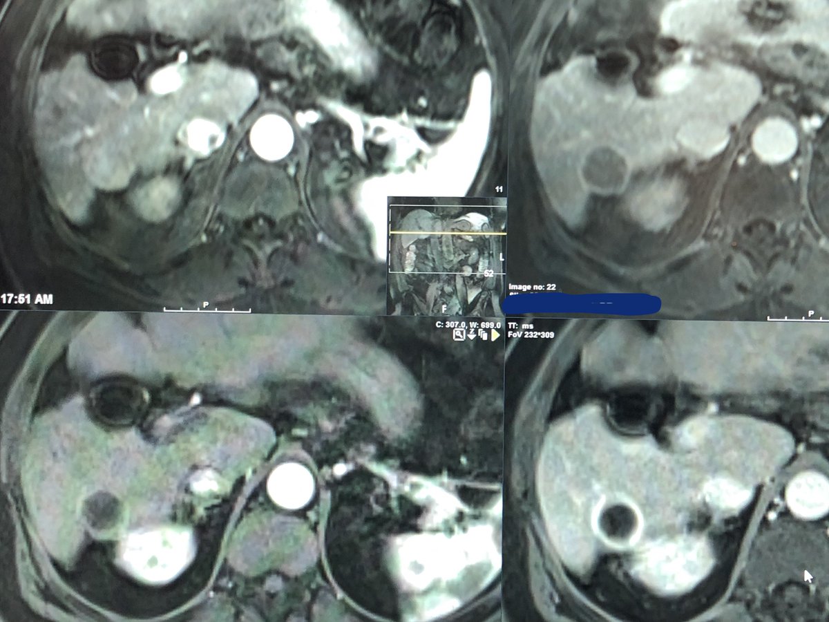 SidTavri's tweet photo. Intrigued by @EmbolxInc Sniper. Trying to exploit changes in downstream flow physiology after balloon occlusion. @JVIRmedia
@SIRspecialists @SIRRFS @UHRadiology
#completeresponse https://t.co/qjKCwsJNw5