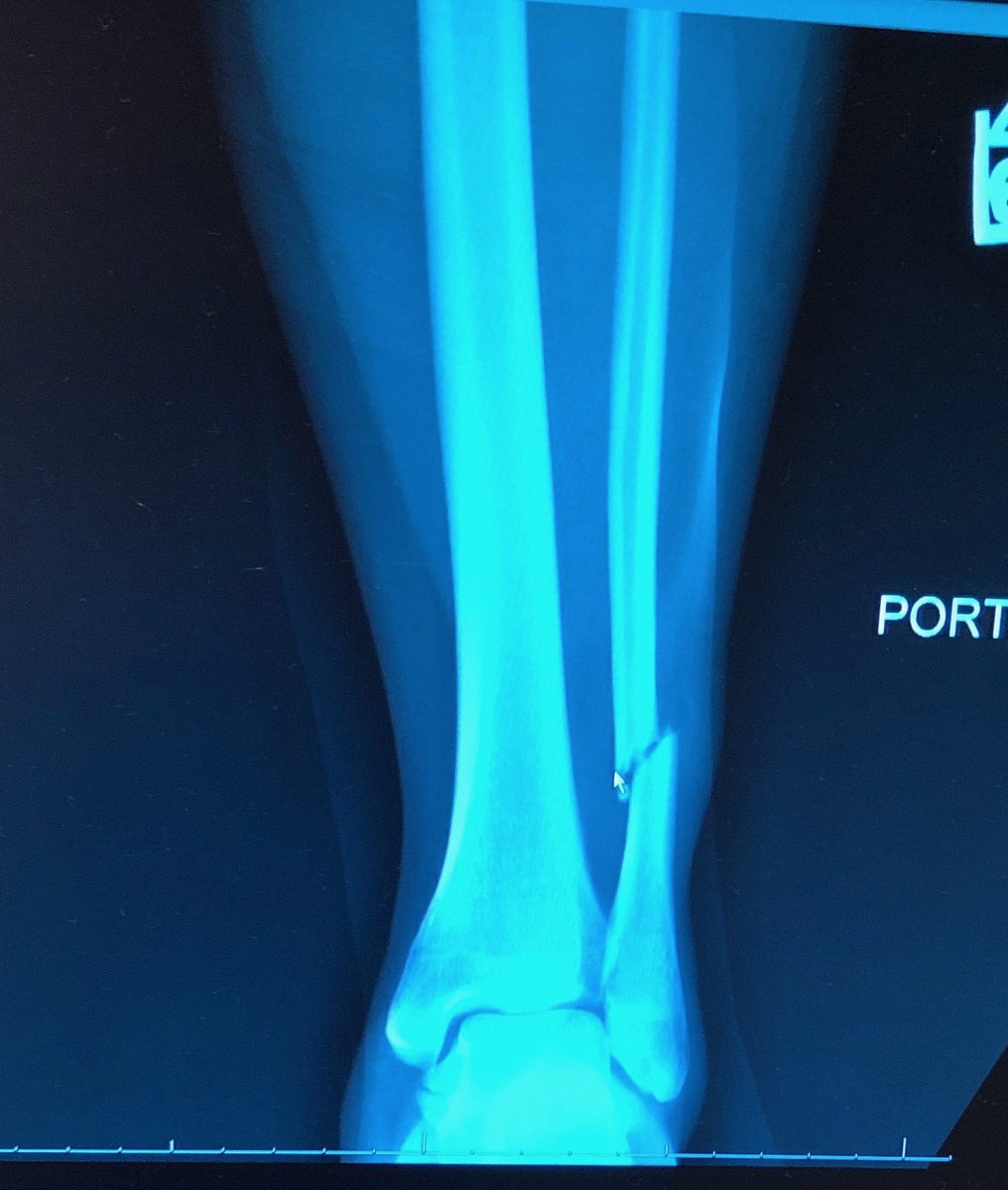 therealestwendy's tweet image. Unfortunately, I won’t be able to finish the #NXTRoadTrip. I’m so proud of the matches I had this weekend and grateful to have the best family, friends &amp;amp; coworkers. My leg is broken, but I will be back! Thanks to all who have reached out and showed me love! #HoldMyDrinkIllBeBack