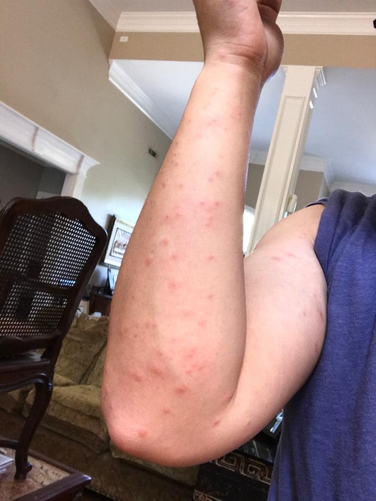 AirbnbDo's tweet photo. @Airbnb @bchesky Apparently Airbnb CSR reps don't think a horrible experience with bedbugs among other things warrants a full refund. Thanks for choosing profits over customers! Great business model! https://t.co/QUZYxnK0I5