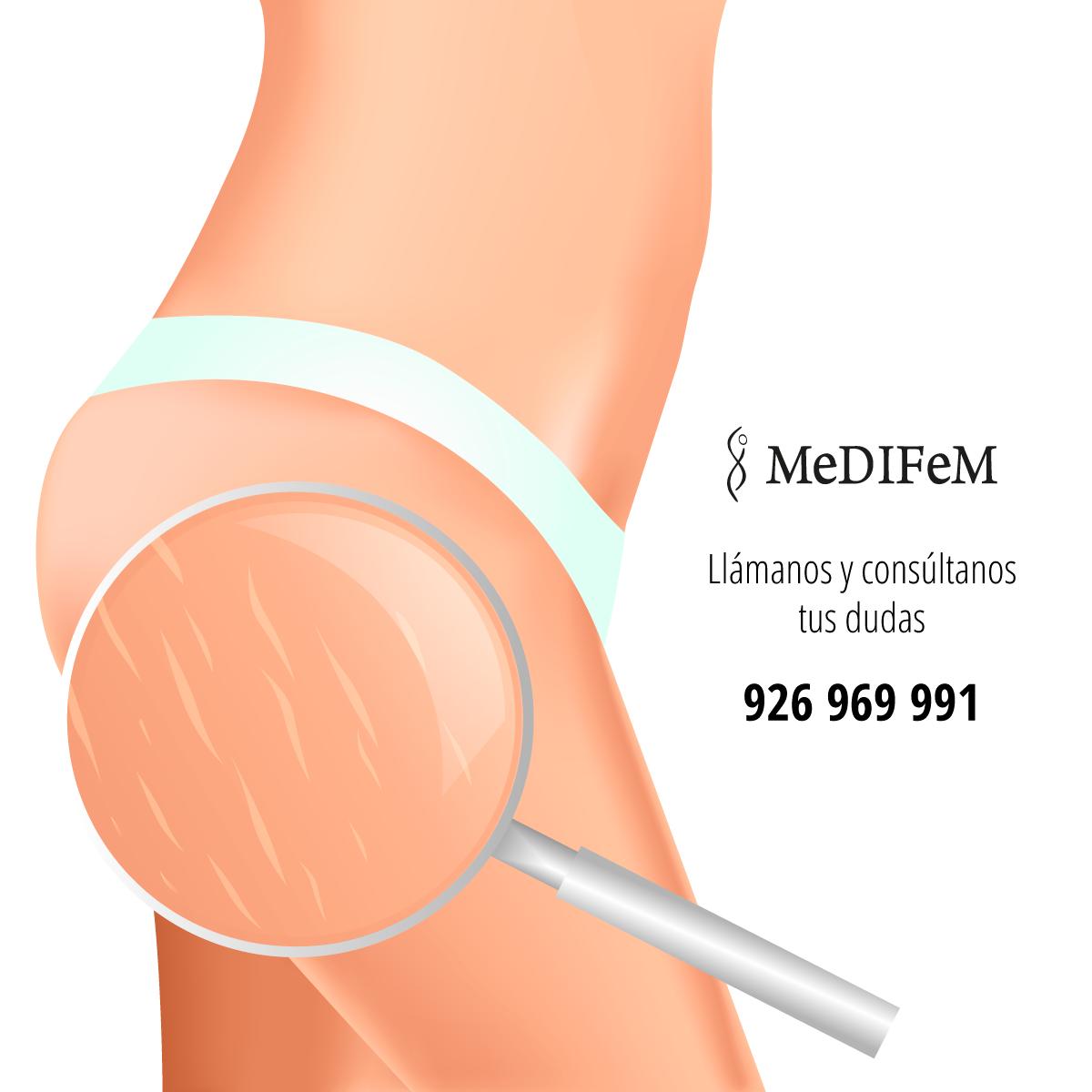 CMEDIFEM's tweet image. ¿Las #estrías son un problema?

Ahora puedes eliminarlas con nuestro tratamiento de #carboxiterapia en pequeñas sesiones.

Llámanos y consúltanos tus dudas 926 969 991

clinicamedifem.es/tratamientos/c…