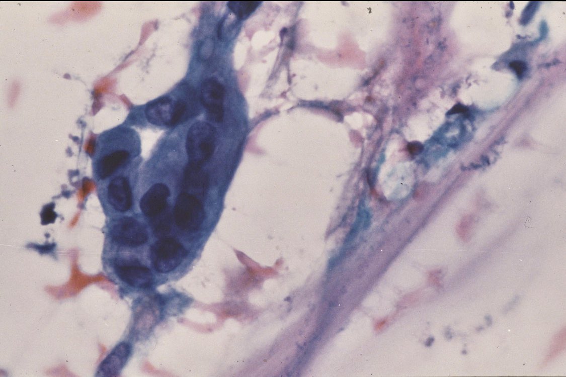 SamKhader's tweet photo. #FNA from an axillary #lymph_node; mlignant glandular cells with abundant extracellular mucin. C/w the hx of mucinous (colloid) #carcinoma of the #breast. To dx this entity 90% of the #tumor should be mucinous. AFIP. @Mycytopathology @SaeedAsiry @A_MatloobMD https://t.co/m9CNV20N9S