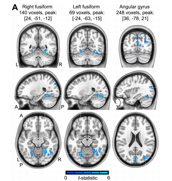 How does mindfulness-based therapy for depression changes patients' brains? <a href="/mlifs1/">Michael Lifshitz</a> &amp; colleagues found effective treatment functionally decouples top-down control regions from sensory, affective &amp; attentional systems #MindRxivMondays <a href="/MindRxiv/">MindRxiv</a> buff.ly/2K05J76