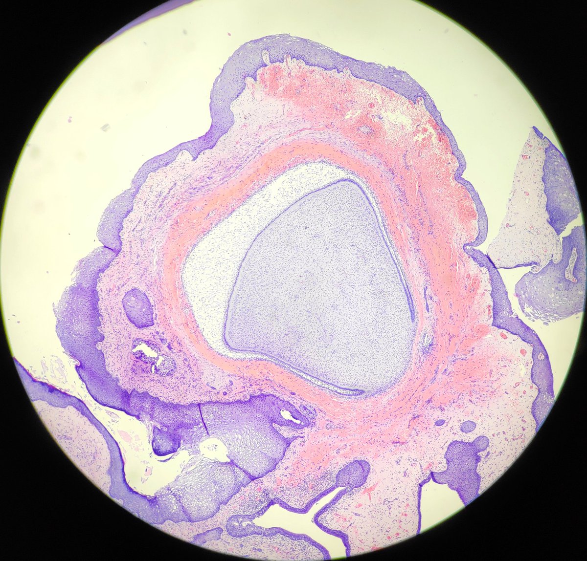 padmapathology1's tweet photo. Late teenager. Mass in abdomen. #WhatAmI #WhereWasI #pathology #pathologists #pathquizz https://t.co/3FR8kpXHFx