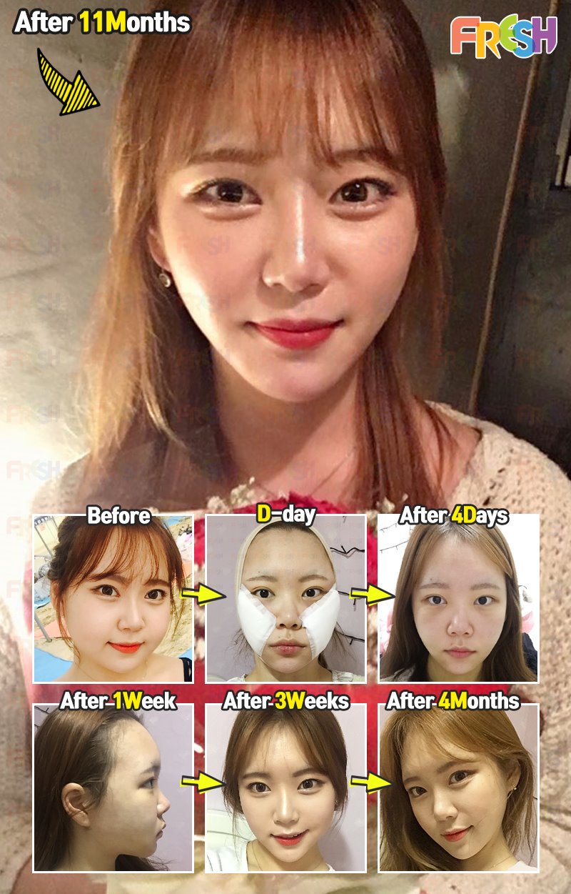 フレッシュ整形外科 一生を顔の大きさで悩んでいた方々のグッドニュース 体は細いのに顔だけ大きいなんて 悲しい方 脂肪移植と脂肪吸引で小顔でシュッとした滑らかなラインをゲット コンプレックスをいつまで持っていますか 今解決しよー