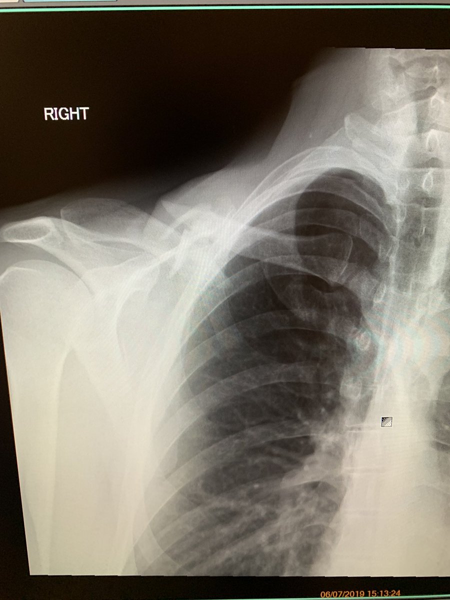 SlightlyJerky's tweet photo. @speedyhaydon I raise you, clavicle in 7 pieces and now cyborg man 16 cm plate and 6 screws. #downhill #mtb #Morzine https://t.co/4bGpoGPft3