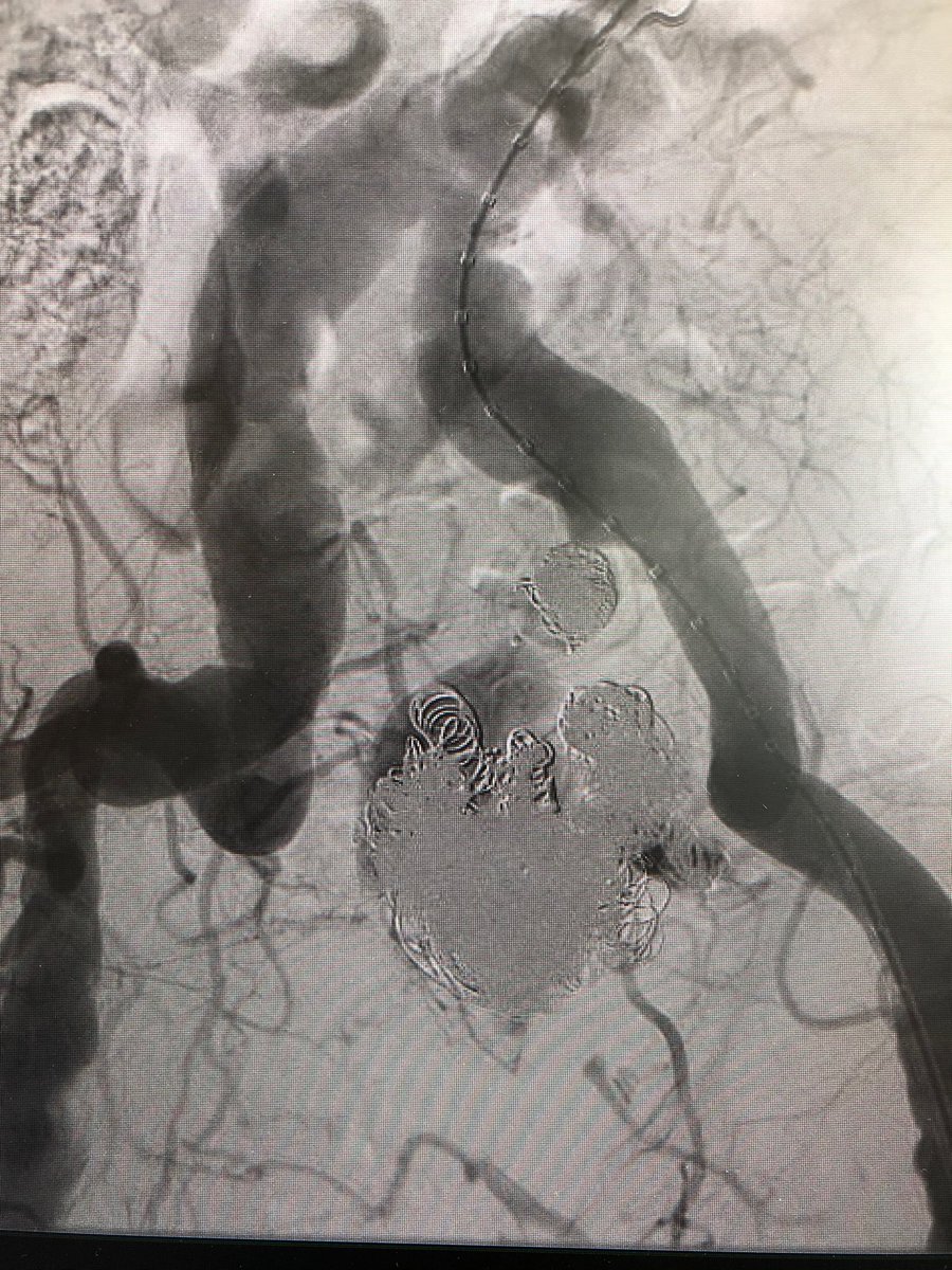 5280vascular's tweet photo. Nonogenarian referred for definitive repair @TMCAvascular @MedCtrofAurora following attempted embolization of 6cm hypogastric aneurysm at OSH. #wireup #ageisnotadisease @HealthONEsystem https://t.co/hf5Ceia1BK
