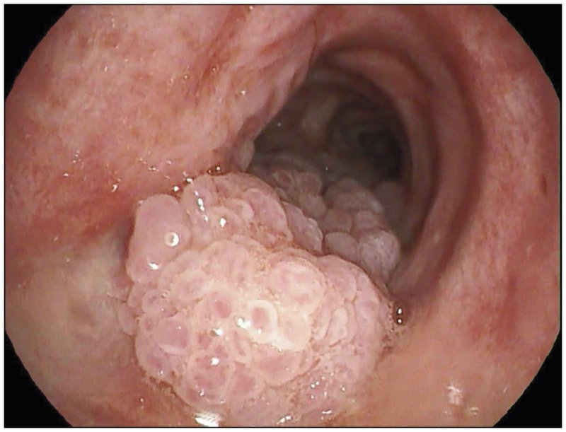 l papillomatosis afla grupa de sange