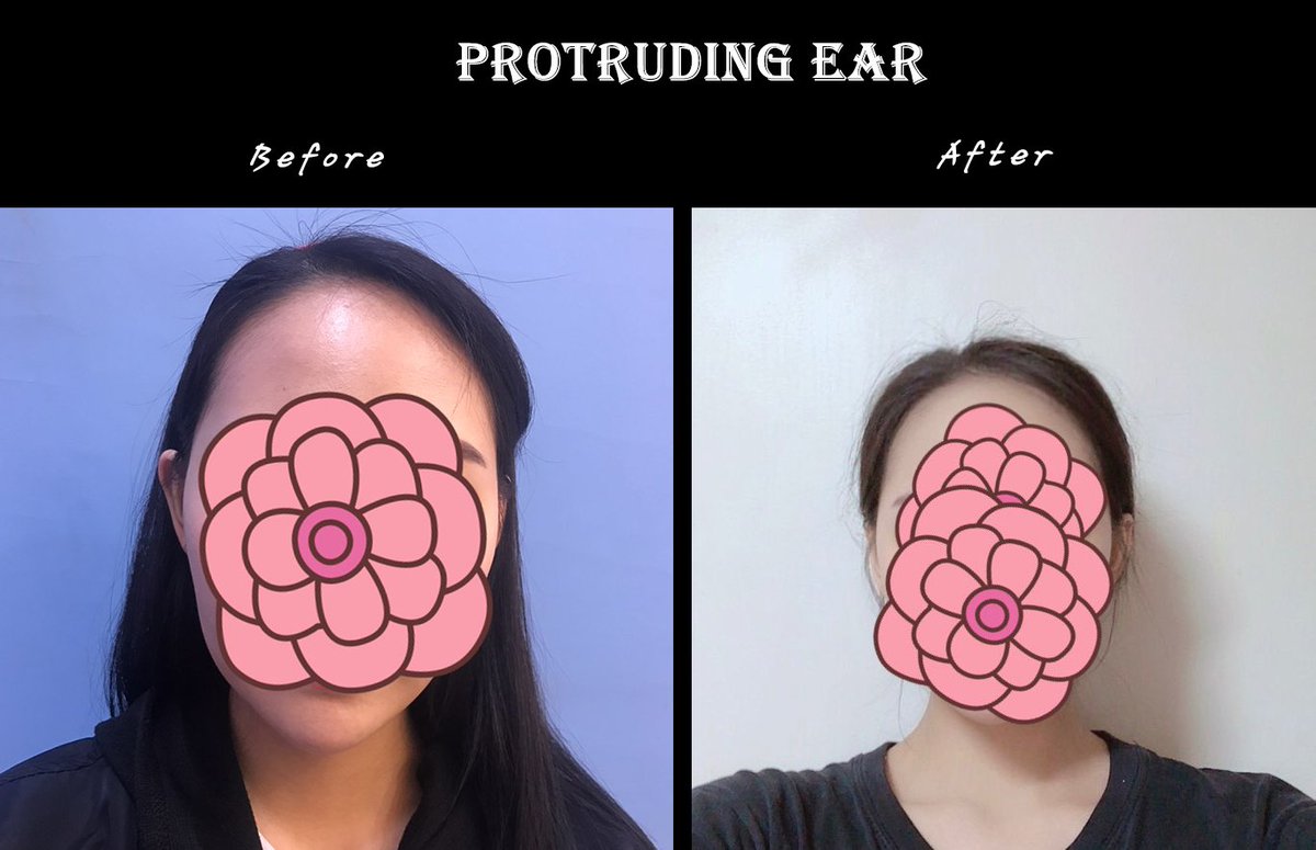 PsSeoul's tweet photo. Before and after pictures of protruding ear surgery. 
#earsurgery #protruding #plasticsurgery #correction #kpop #selfies #beforeandafter #SOUTHKOREA https://t.co/7O3PtkcsJ5