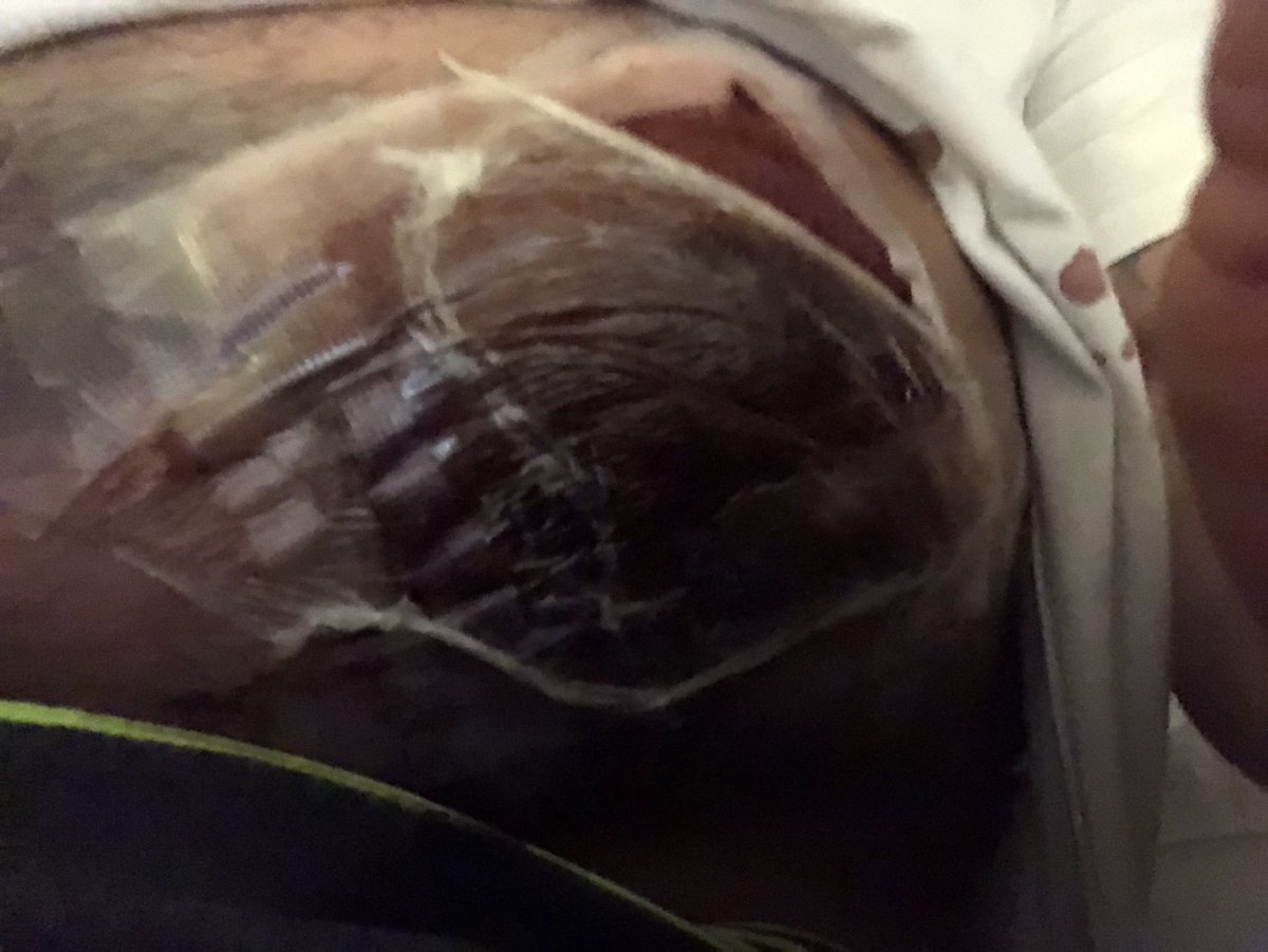 TjSchmitt3's tweet photo. Recovery from recent surgery ! https://t.co/tNCT7zc2i9